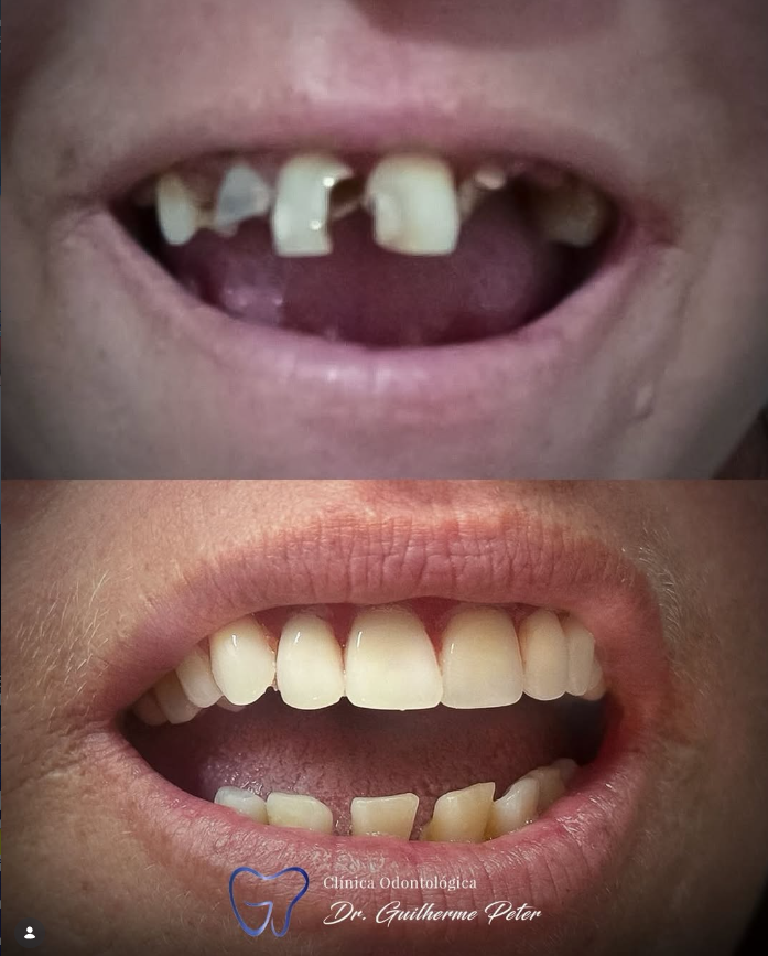 Resultado antes e depois 1