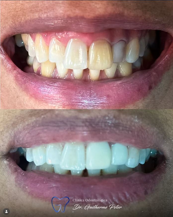 Resultado antes e depois 2