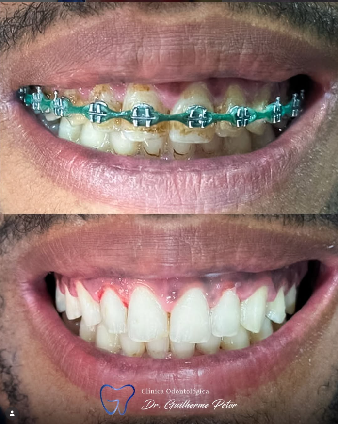 Resultado antes e depois 4