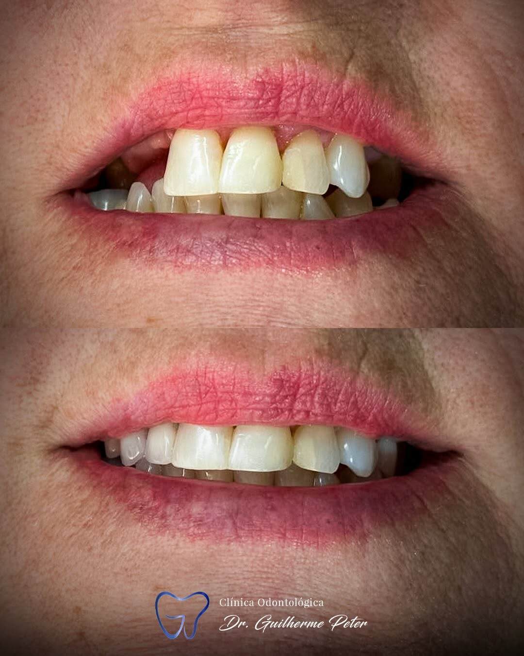 Resultado antes e depois 5